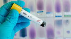 ​Bu əlamətlər sizdə varsa, hepatitsiniz - DİQQƏT