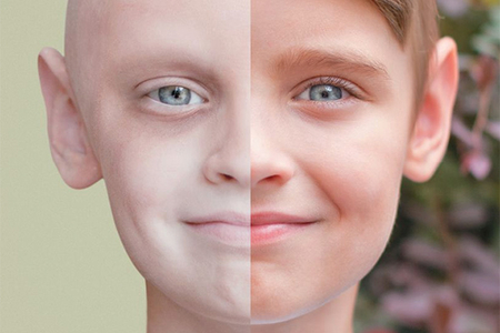 Qan xərçənginə yoluxan uşaqların sayı artıb – Sürətli arıqlama, qızdırma, səpki ...