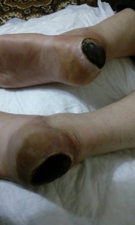 "Vimay" Klinikasında həkim səhlənkarlığının qurbanına çevrilən xəstə