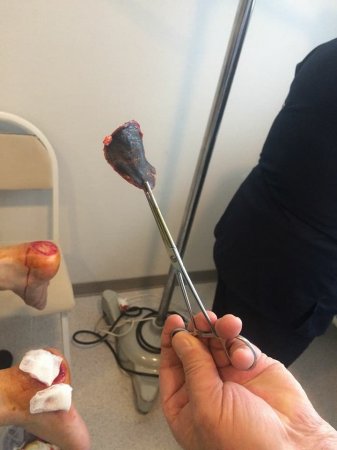 "Vimay" Klinikasında həkim səhlənkarlığının qurbanına çevrilən xəstə