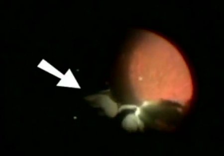 Donuz əti yeyən adamın gözündən görün nə çıxdı - DƏHŞƏT / FOTOLAR