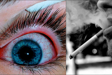 Türkiyəli mütəxəssisdən XƏBƏRDARLIQ: “Siqaret tüstüsü gözləri kor edir”