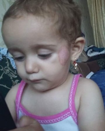 Daha bir bağçada uşağa qarşı şiddət: Üzünə dağ basdılar – FOTOLAR