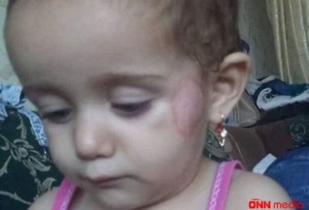 Uşaq bağcasında dağlandığı iddia olunan uşaqla bağlı həkim rəyi açıqlandı