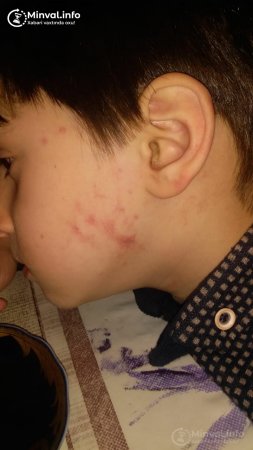 Bağçada uşağa qarşı zorakılıq – Müəllim 5 yaşlı uşağı bu hala saldı? (FOTO)