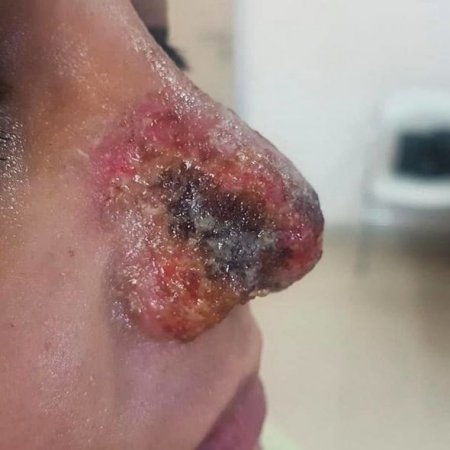 Azərbaycanda dəhşət: kosmetoloq qızın burnunu çürütdü – FOTO 