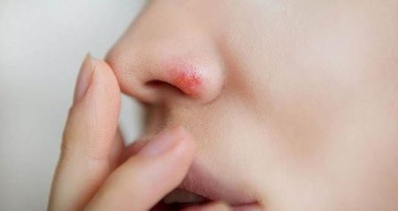 Azərbaycanda dəhşət: kosmetoloq qızın burnunu çürütdü – FOTO