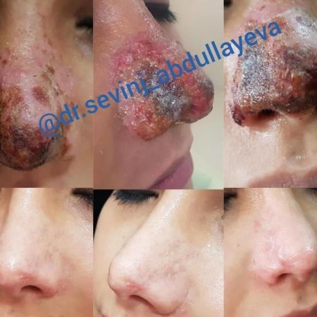 Azərbaycanda dəhşət: kosmetoloq qızın burnunu çürütdü – FOTO 