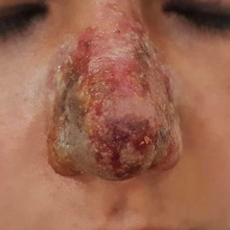 Azərbaycanda dəhşət: kosmetoloq qızın burnunu çürütdü – FOTO 