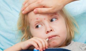 Ukraynada qızılcadan ölənlərin sayı 16 nəfərə çatdı