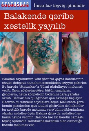 Balakəndə naməlum xəstəlik yayılıb? - Rəsmi açıqlama