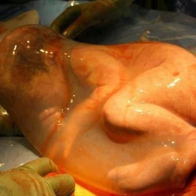 “Köynəkdə” doğulan uşaq hər kəsi heyrətə gətirdi - FOTO “Köynəkdə” doğulan uşaq hər kəsi heyrətə gətirdi - FOTO