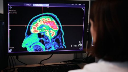 Bu şəxslərdə beyin daha kiçikdir - ARAŞDIRMA..