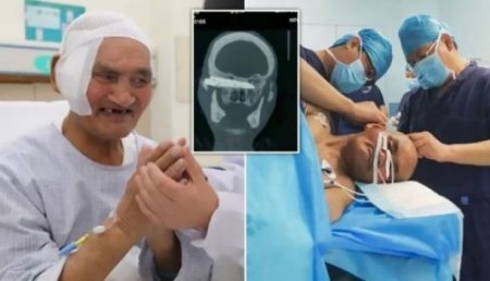 Həkimlər kişinin başında 26 il qalan bıçağı çıxardılar - FOTO