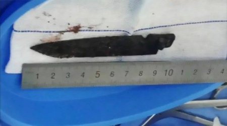 Həkimlər kişinin başında 26 il qalan bıçağı çıxardılar - FOTO