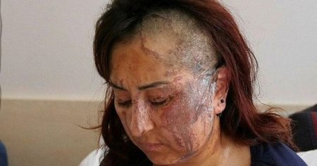 Boşanmaq istəyən arvadını belə yandırdı - FOTO