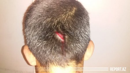 Ata dilənmək istəməyən 11 yaşlı oğlunu başından bıçaqladı - Fotolar 