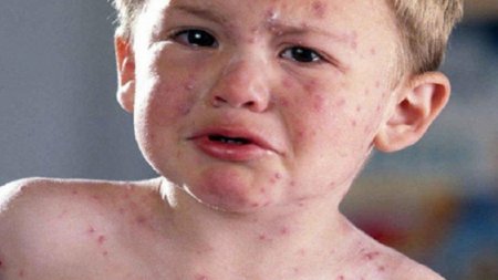 Uşaqlar arasında yayılan koksaki: Ələmətləri və təhlükələri...