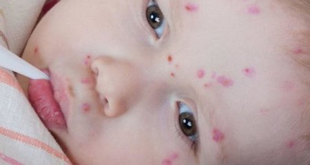 TƏBİB suçiçəyi ilə bağlı ÜST-ə müraciət etdi