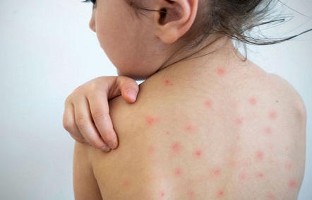 “Qızılcanın müalicəsi ilə bağlı dərman təminatı ən üst səviyyədədir” - Vüqar Qurbanov